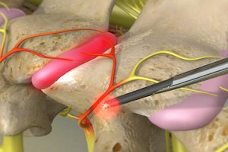 cervfacetneurotomy_300