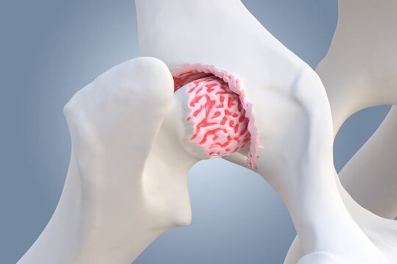 osteoarthritis of the hip